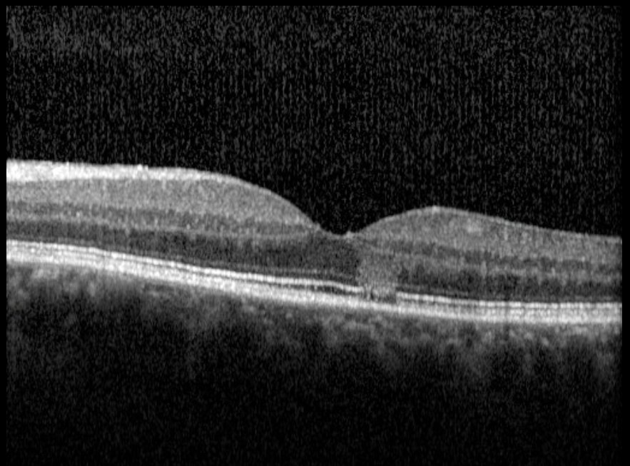 Macular OCT left eye at presentation