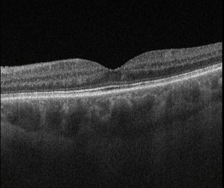 Macular OCT left eye 2 months after presentation