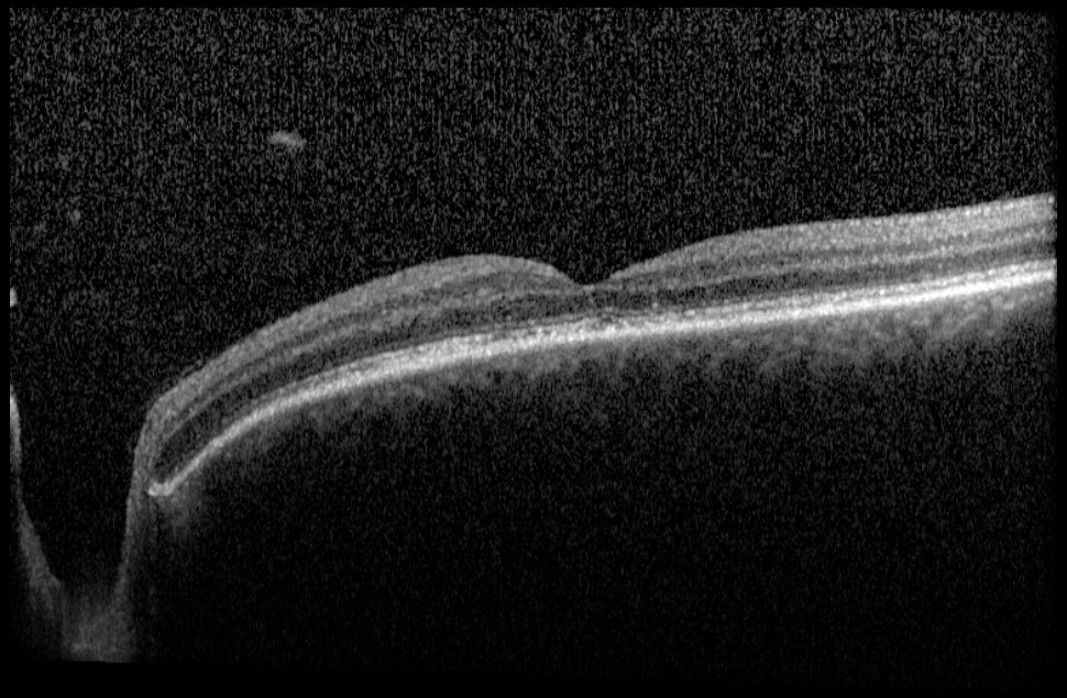 Macular OCT - left eye