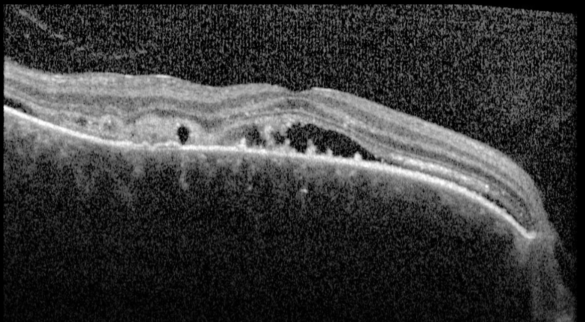 Macular OCT - right eye