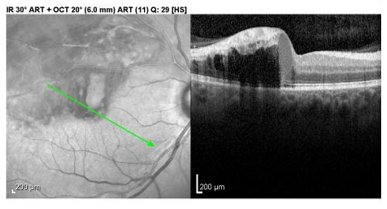 OCT four weeks after presentation
