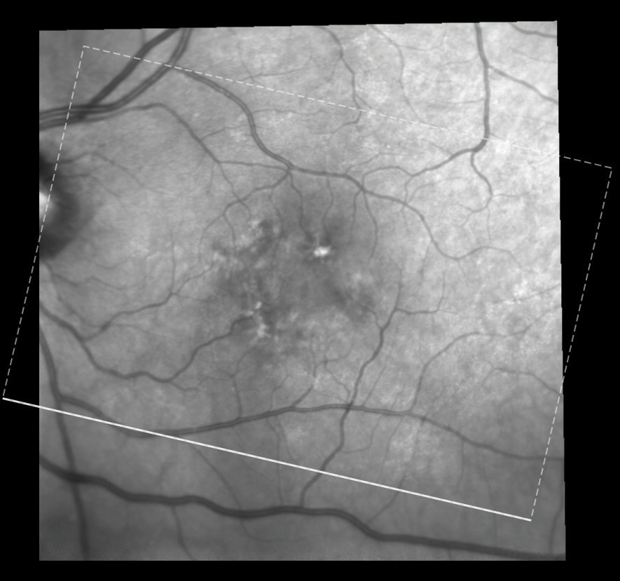 Near-infrared fundus image - left eye