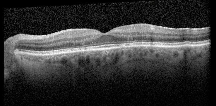 Macular OCT - left eye