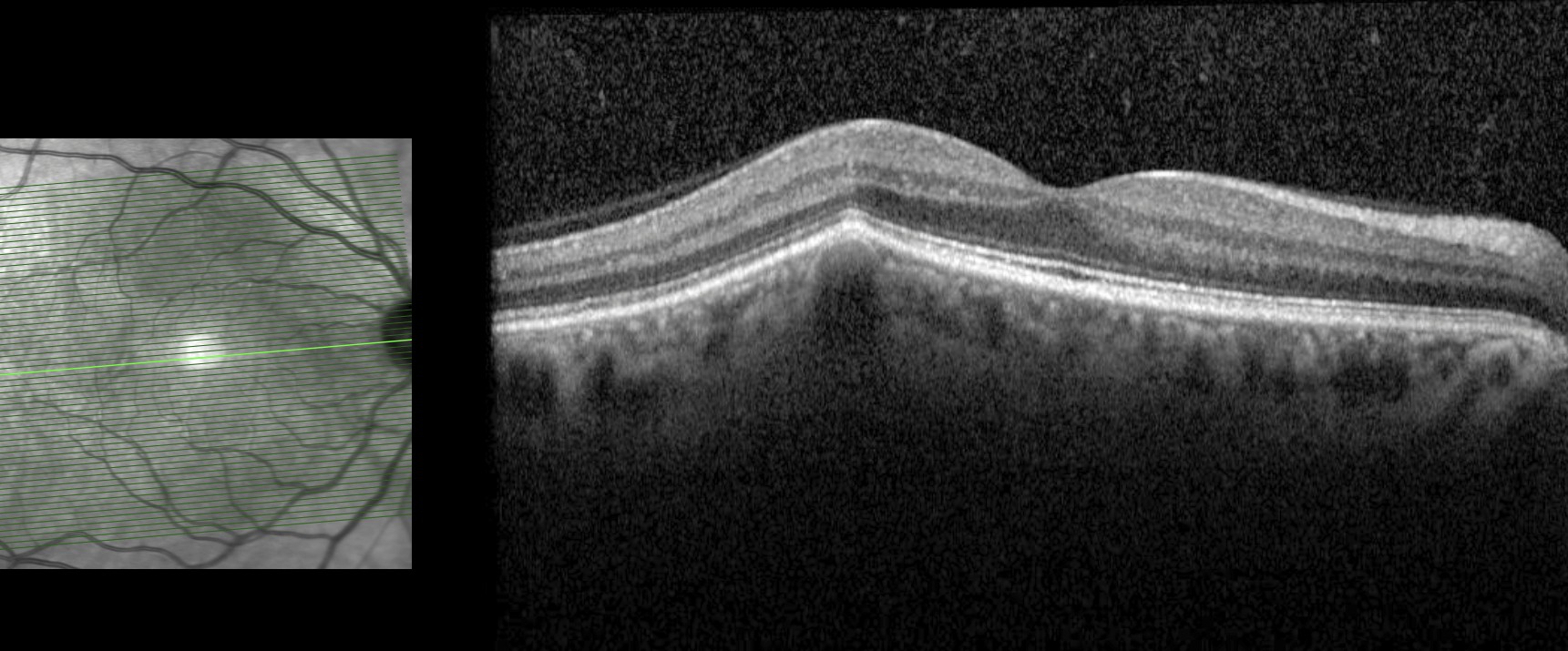 Macular OCT - right eye