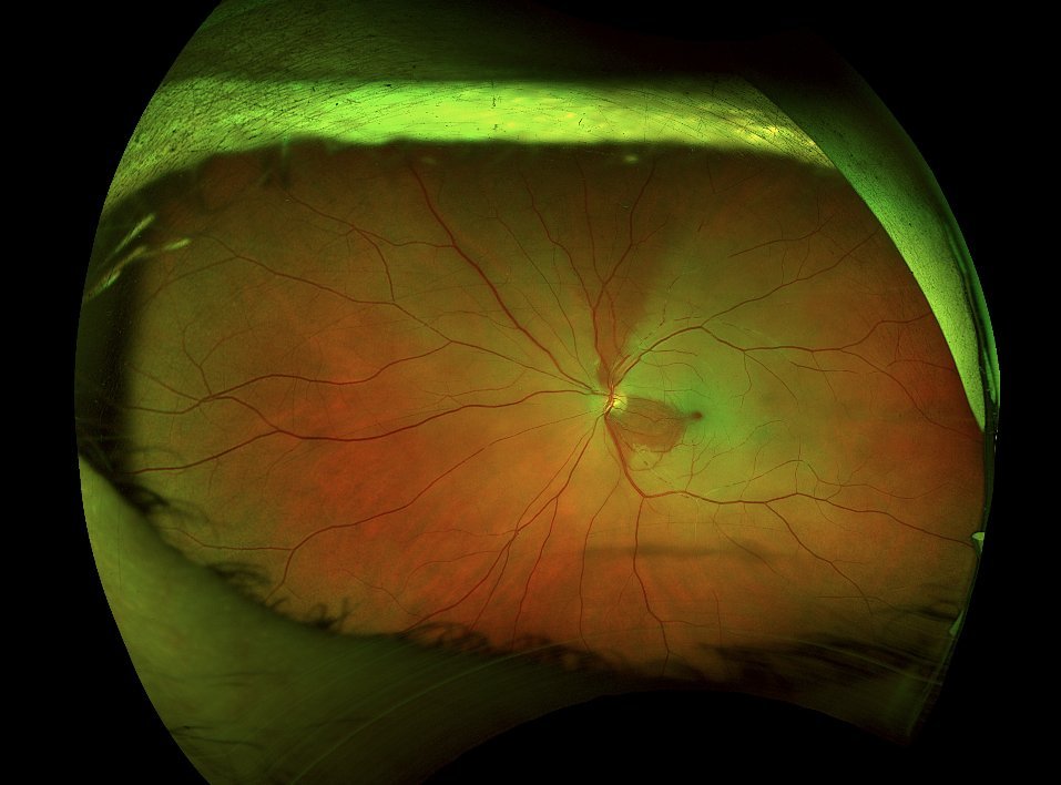 Widefield colour fundus photograph - left eye, February 2026