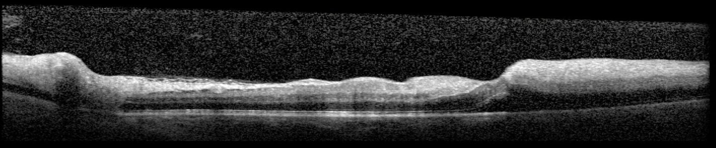 Macular OCT - left eye, February 2026