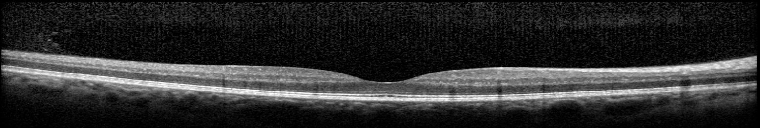 Macular OCT - right eye, February 2026