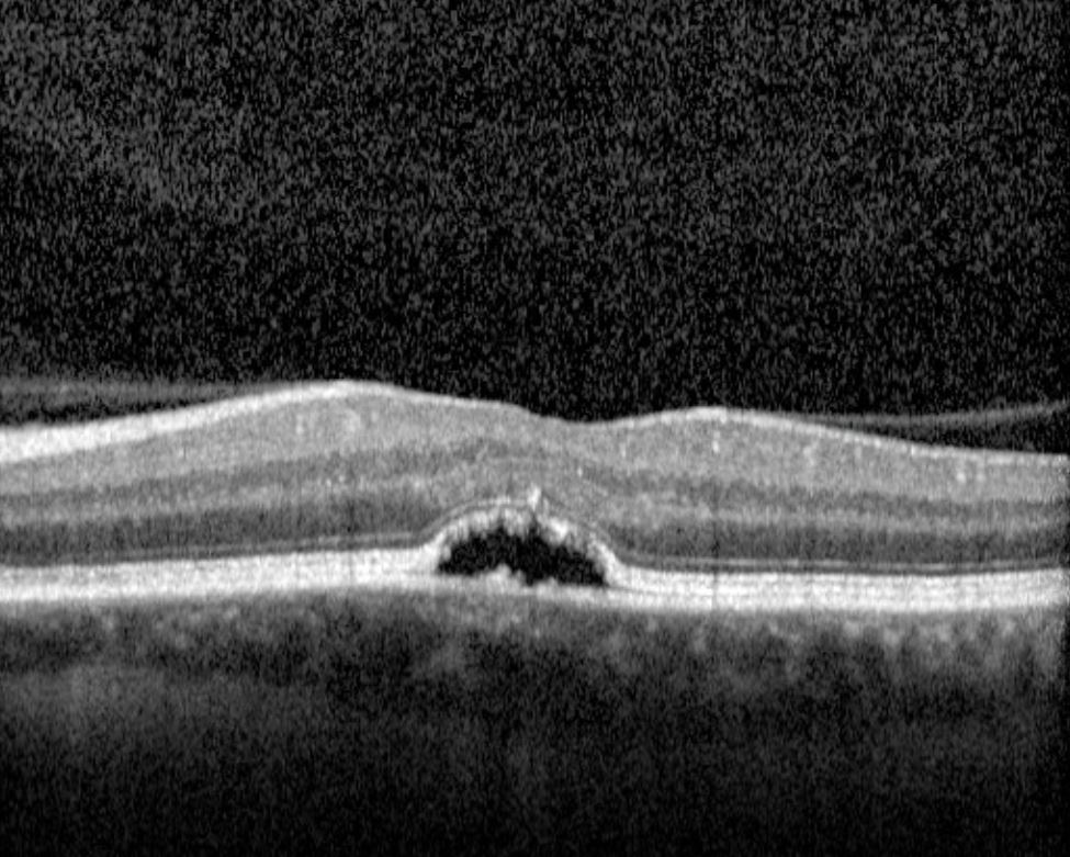OCT scan central macula left eye