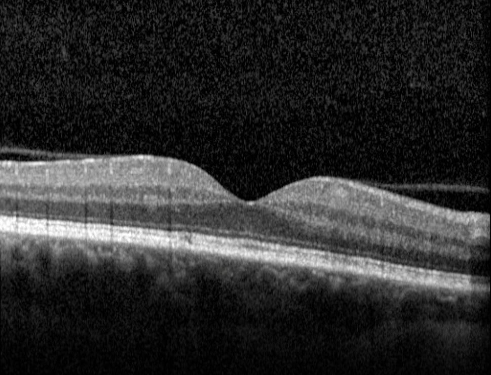 OCT scan central macula right eye