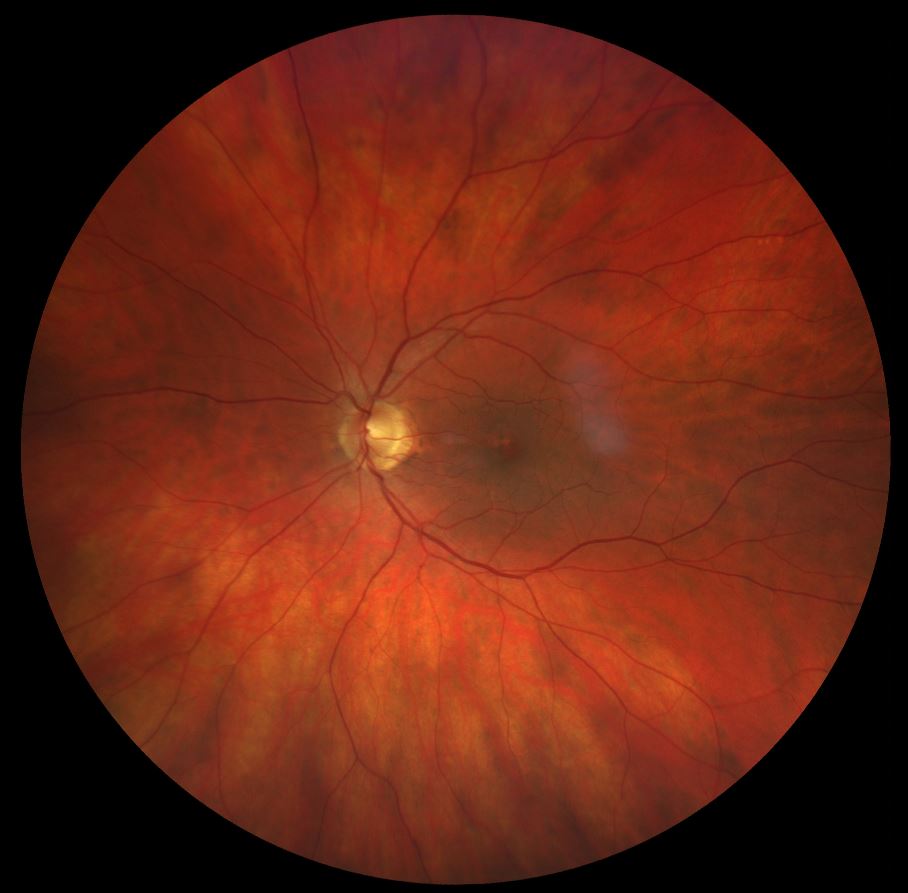 Colour fundus photograph right eye