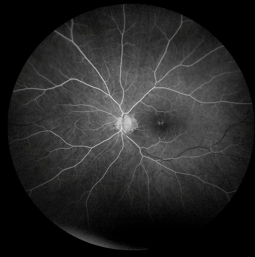 FFA left eye (early venous phase)