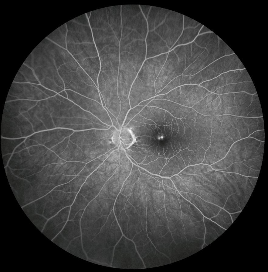 FFA left eye (arteriovenous phase)