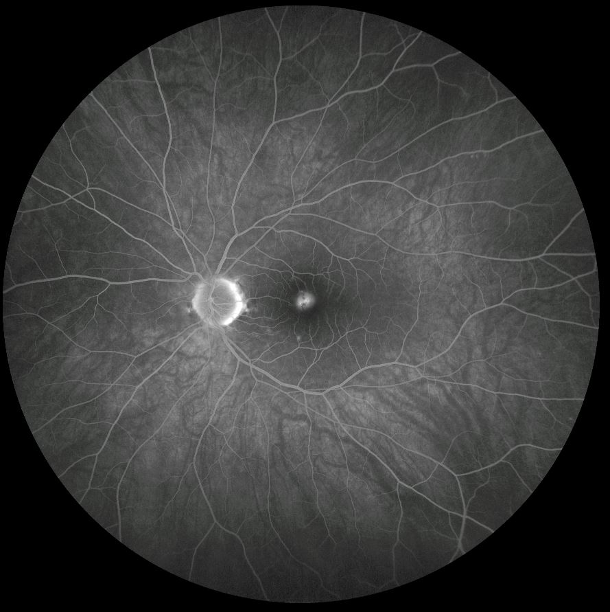 FFA left eye (late phase)