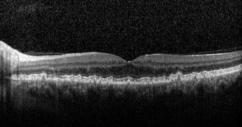 Macular OCT - left eye