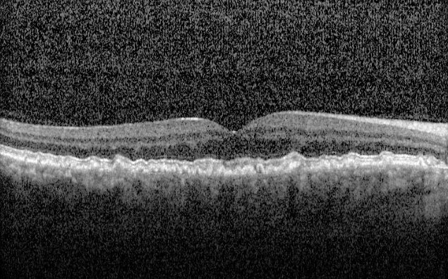 Macular OCT - right eye