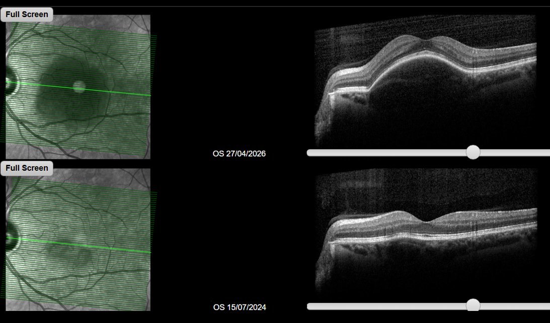 Comparative macular OCT - left eye