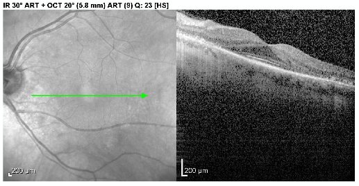 OCT left macula