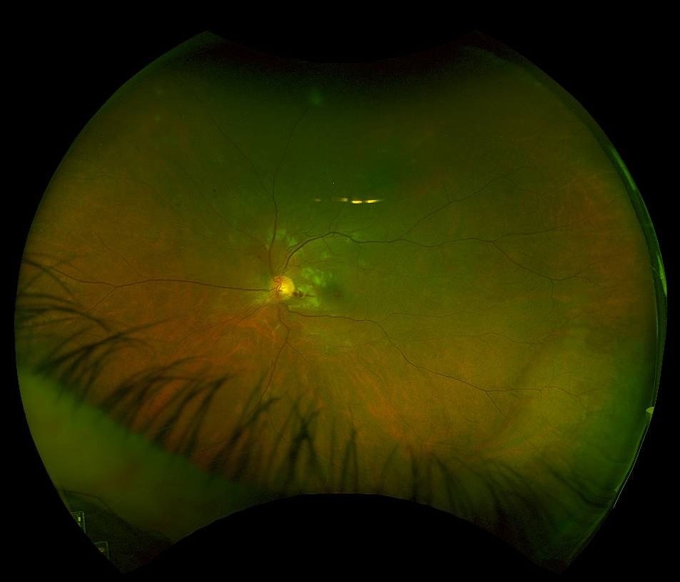 Widefield colour fundus photograph - left eye