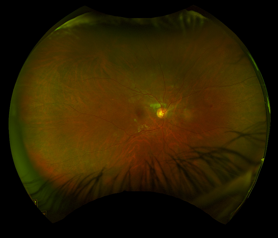 Widefield colour fundus photograph - right eye