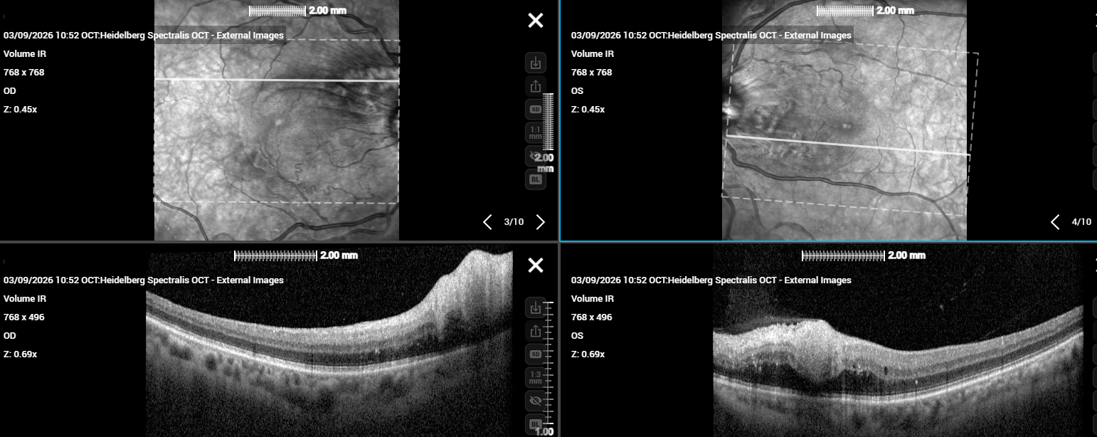 Bilateral macular OCT