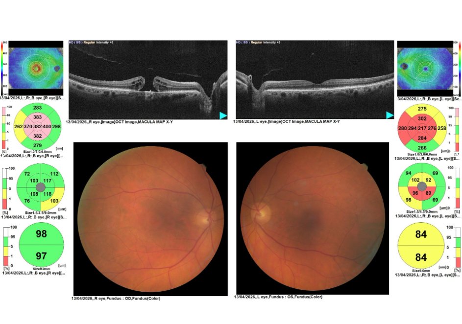 Bilateral macular OCT with thickness maps and colour fundus photographs