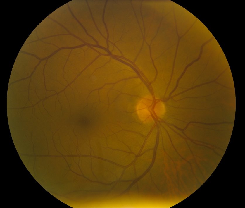 Colour fundus photograph – right eye