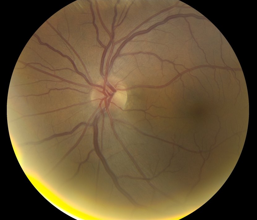 Colour fundus photograph – left eye