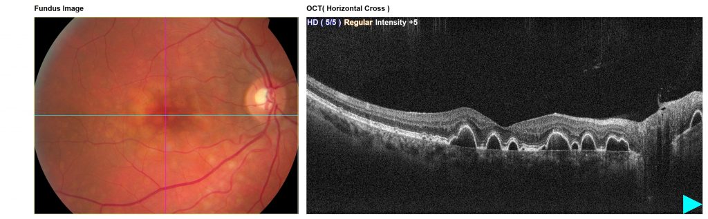 Colour photograph and OCT scan – right macula