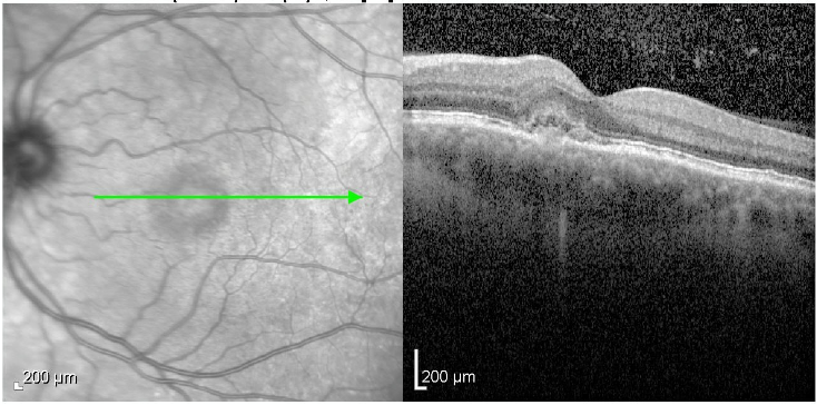 Macular OCT - left eye at presentation, 2018
