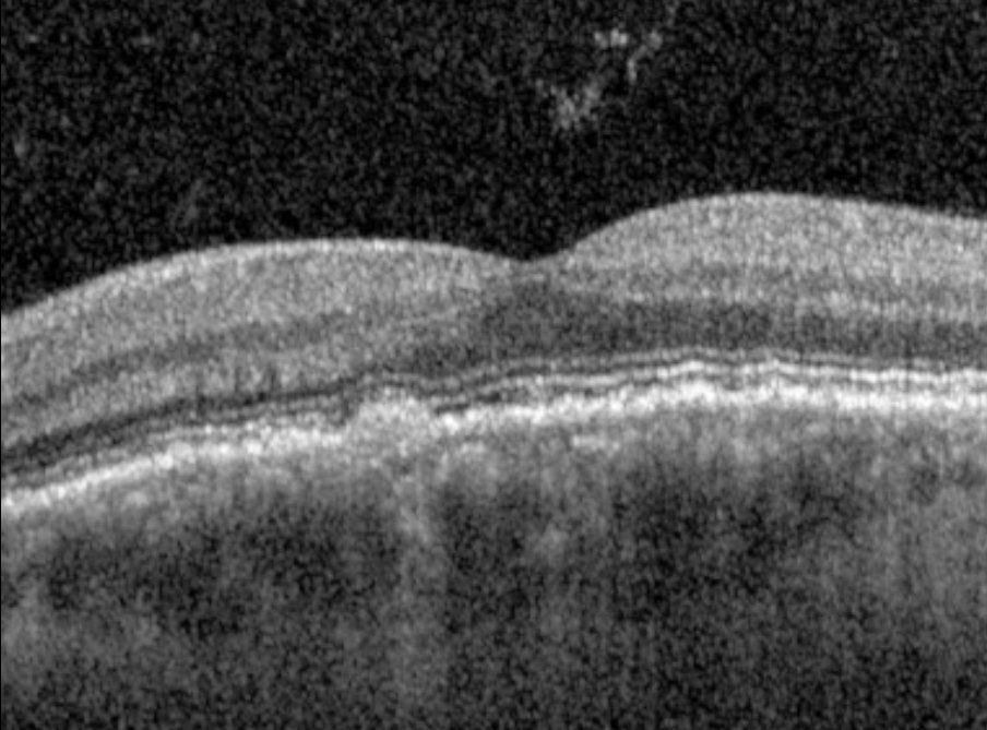 Macular OCT - left eye, September 2026