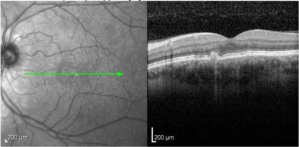Macular OCT - left eye after treatment