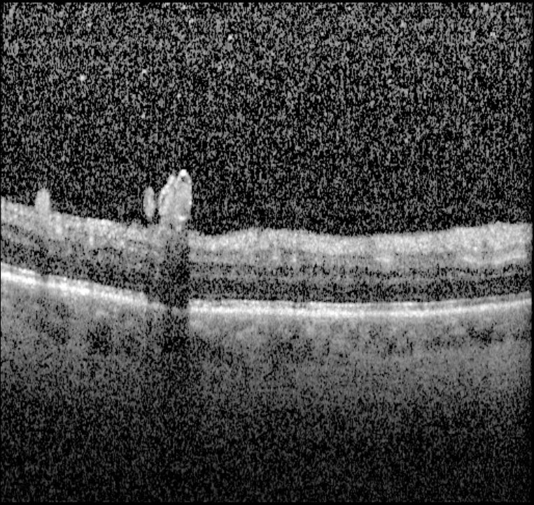 OCT scan inferior macula right eye
