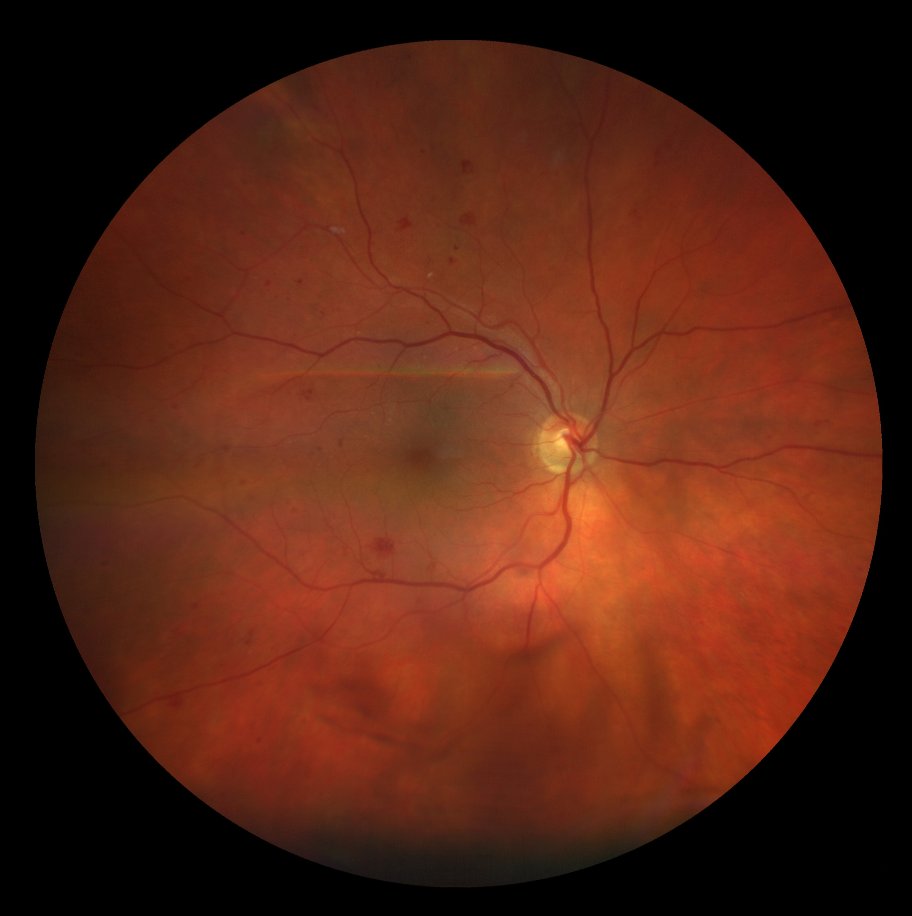 Widefield colour photograph of right fundus