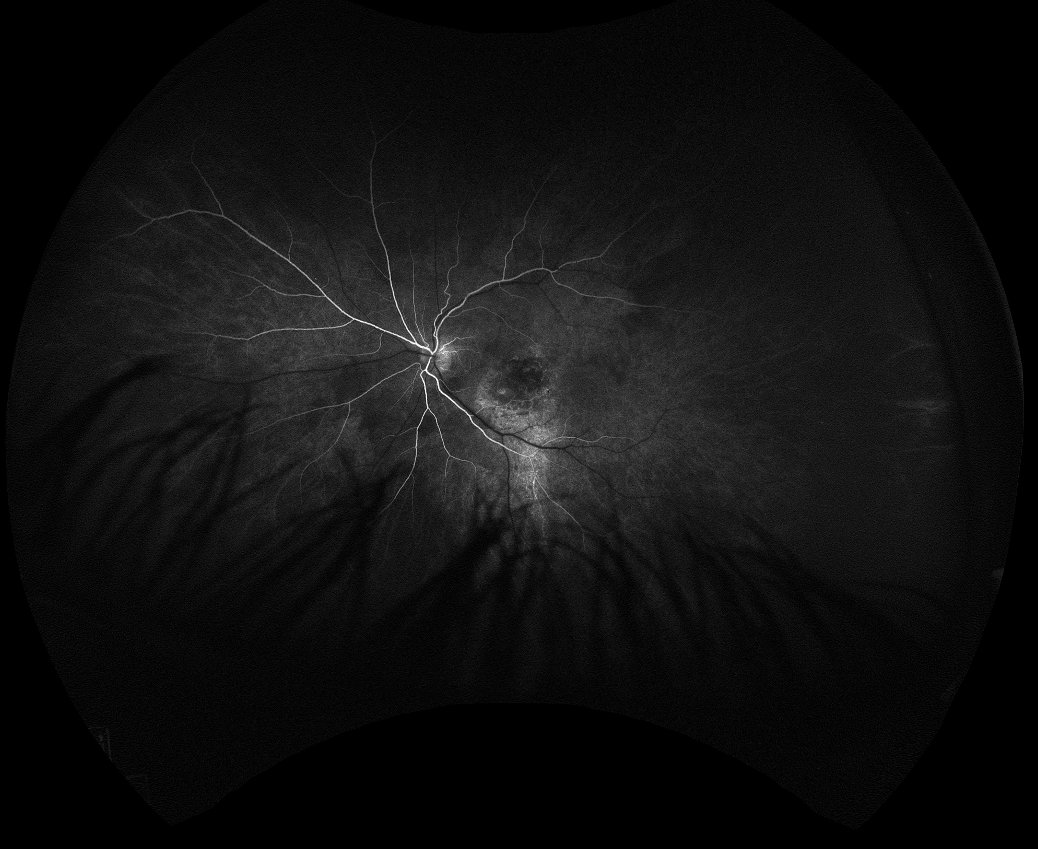 Fluorescein angiography - early phase, 17 seconds