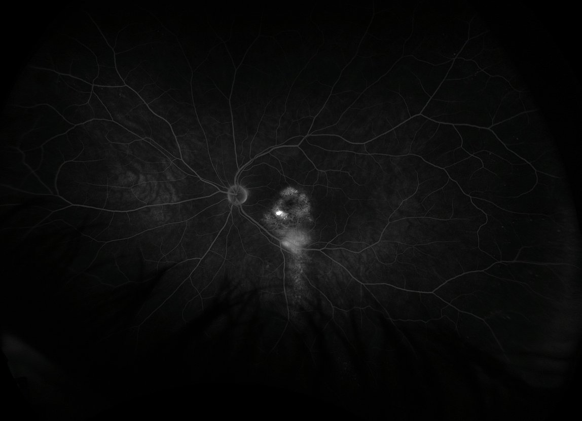 Fluorescein angiography - late phase, 9 minutes