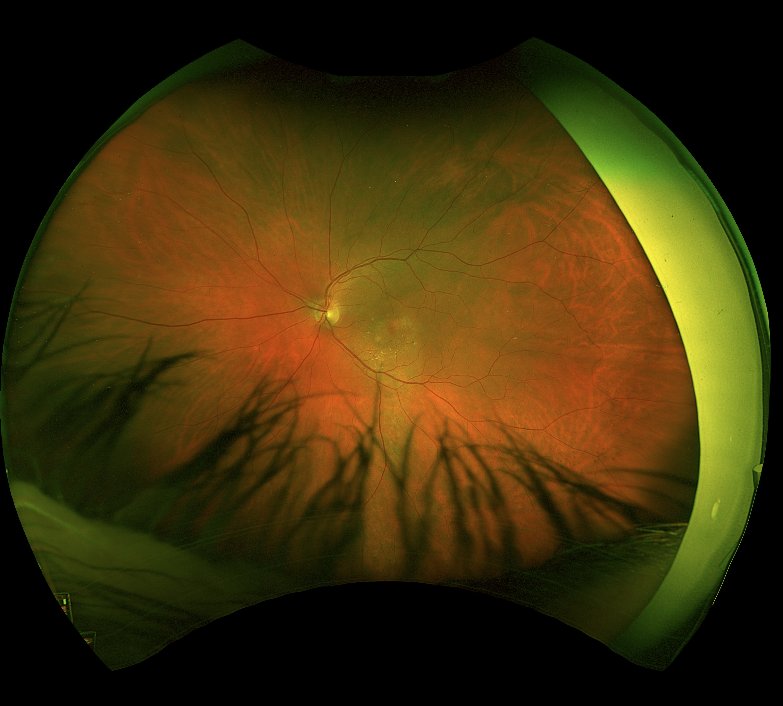 Widefield colour fundus photograph - left eye