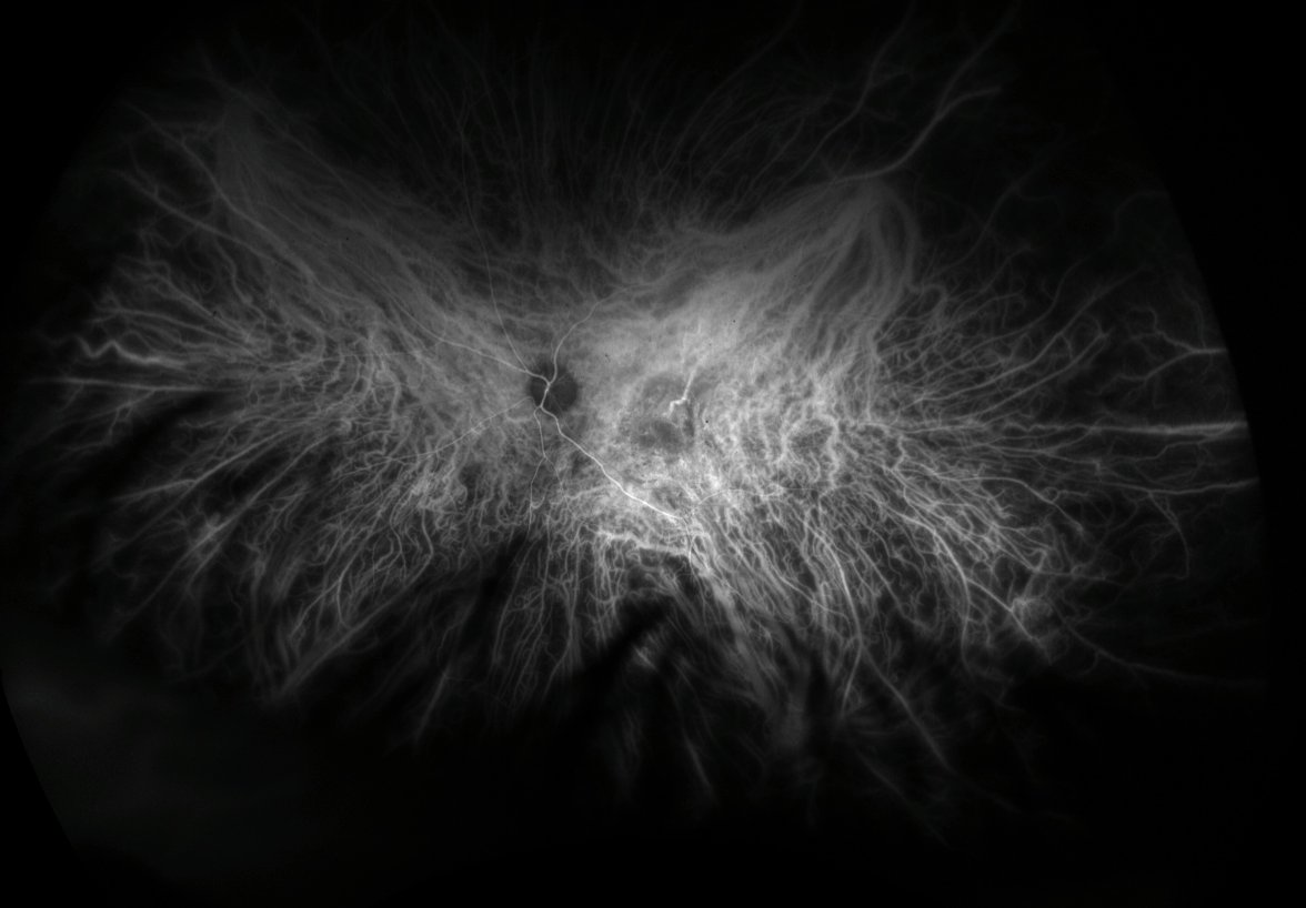 ICG angiography - early phase, 20 seconds