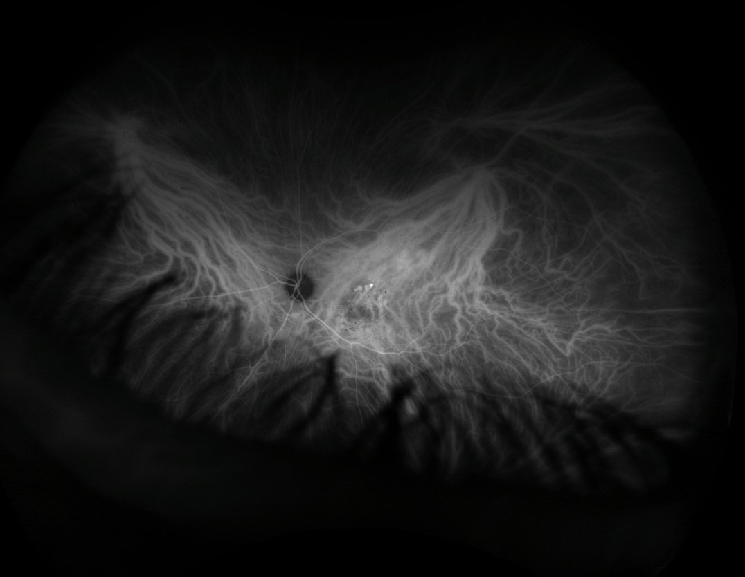 ICG angiography - mid phase, 4 minutes