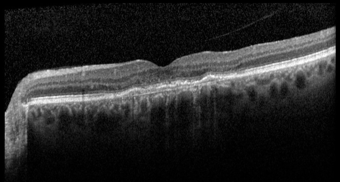 Macular OCT - left eye, four weeks after Eylea loading course
