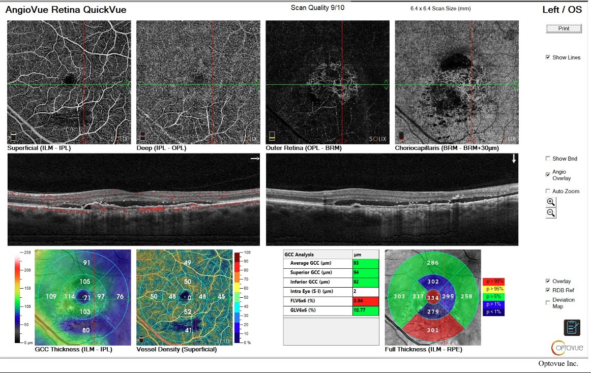 OCT angiography - left eye overview