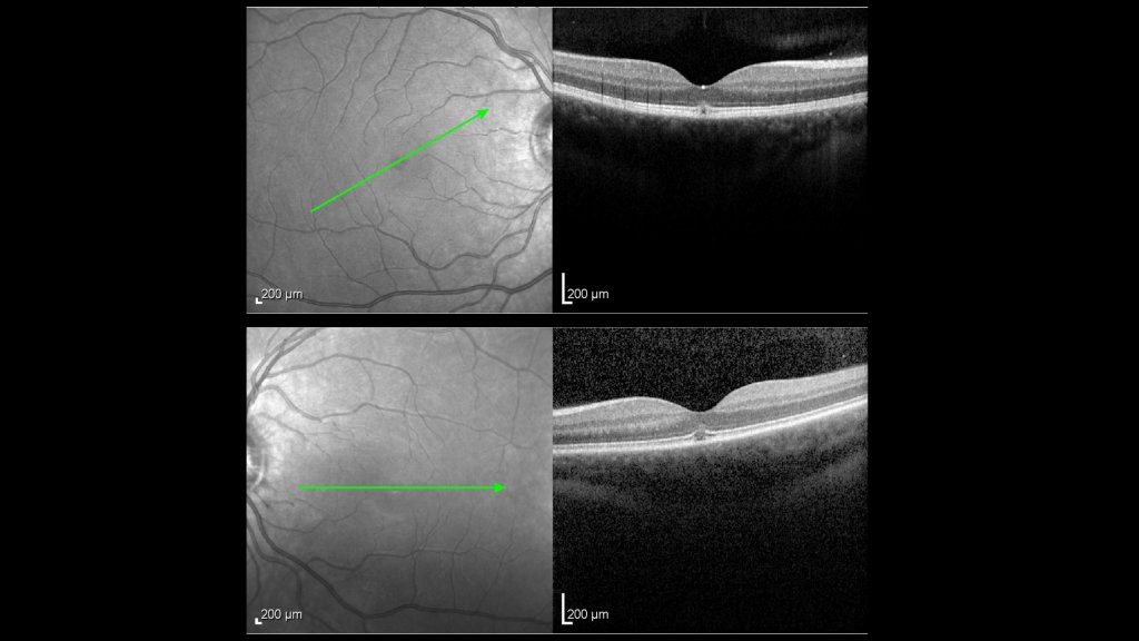 Macular OCT scans: top right eye; bottom left eye
