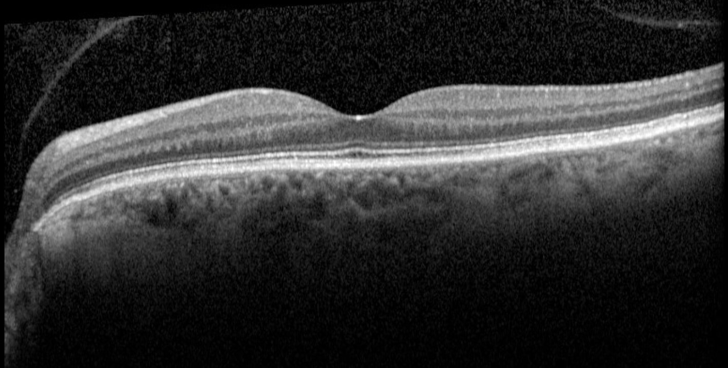 Macular OCT - left eye