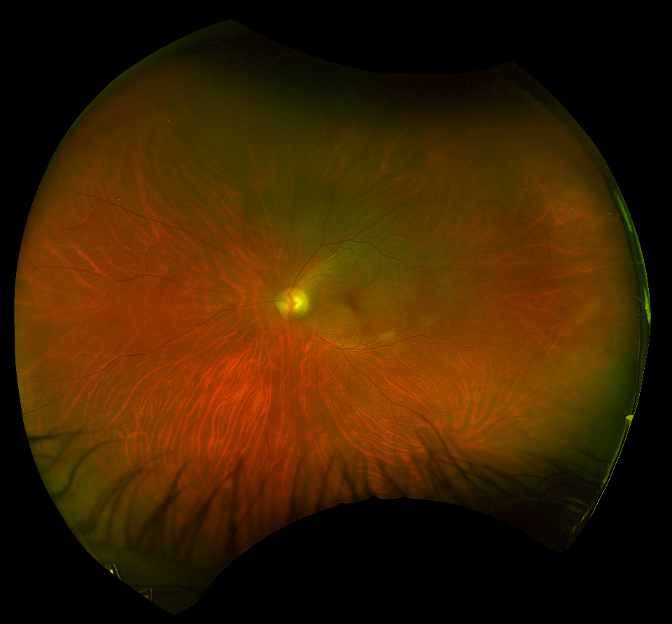 Widefield colour fundus photograph - left eye