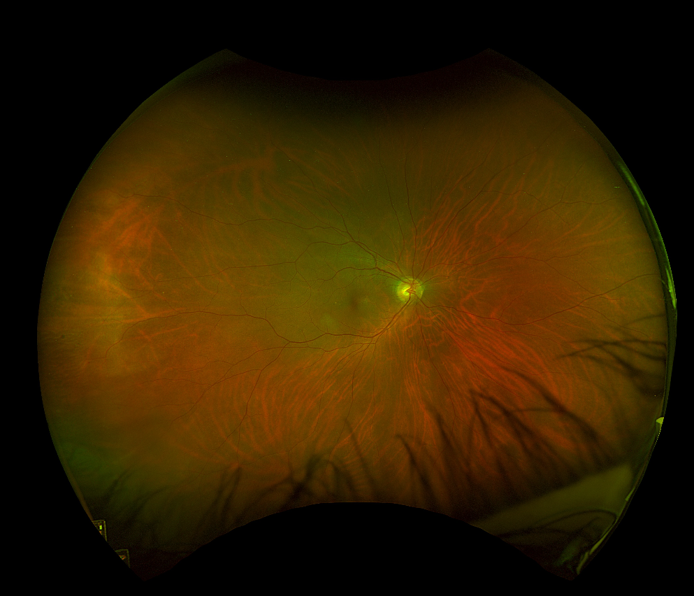 Widefield colour fundus photograph - right eye
