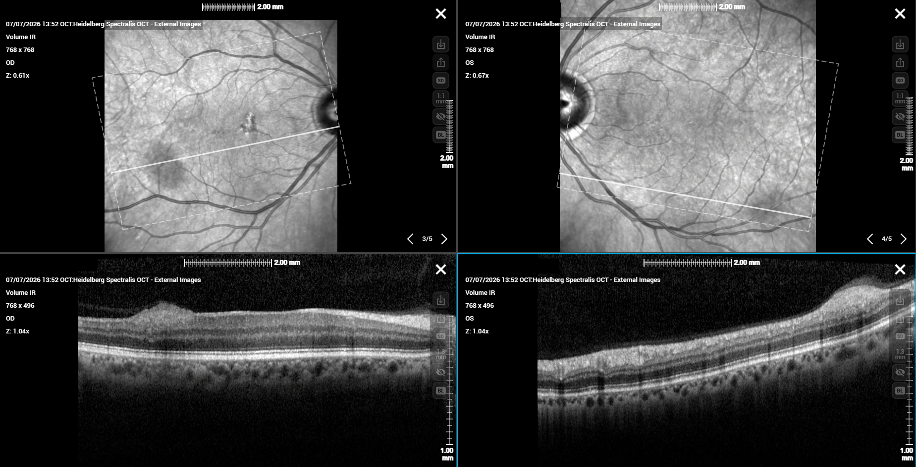 Bilateral macular OCT - right and left eyes, clinic visit 7 July 2026